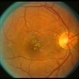 Leber's Stellate Maculopathy
